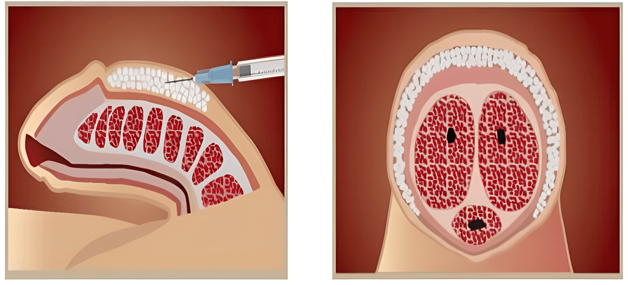 filler injection area