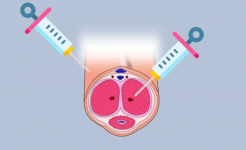 site for hyaluronic acid injection
